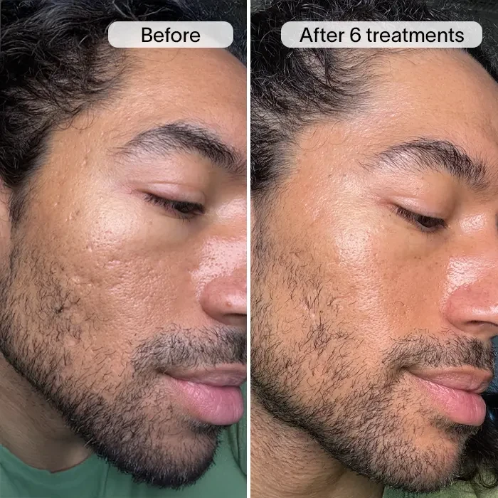 PDRN Advanced Infusion Treatment for Acne Scars