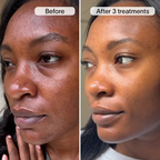 PDRN Advanced Infusion Treatment for Acne Scars