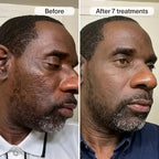 PDRN Advanced Infusion Treatment for Acne Scars