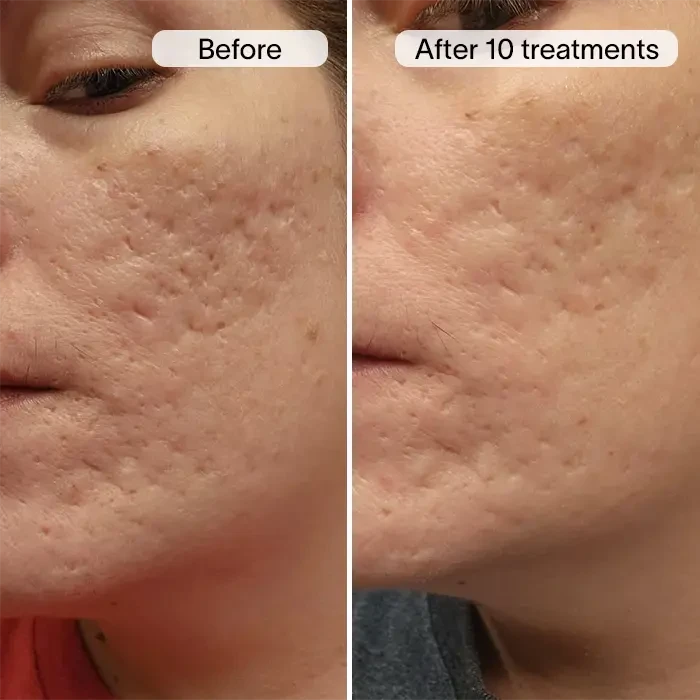 PDRN Advanced Infusion Treatment for Acne Scars