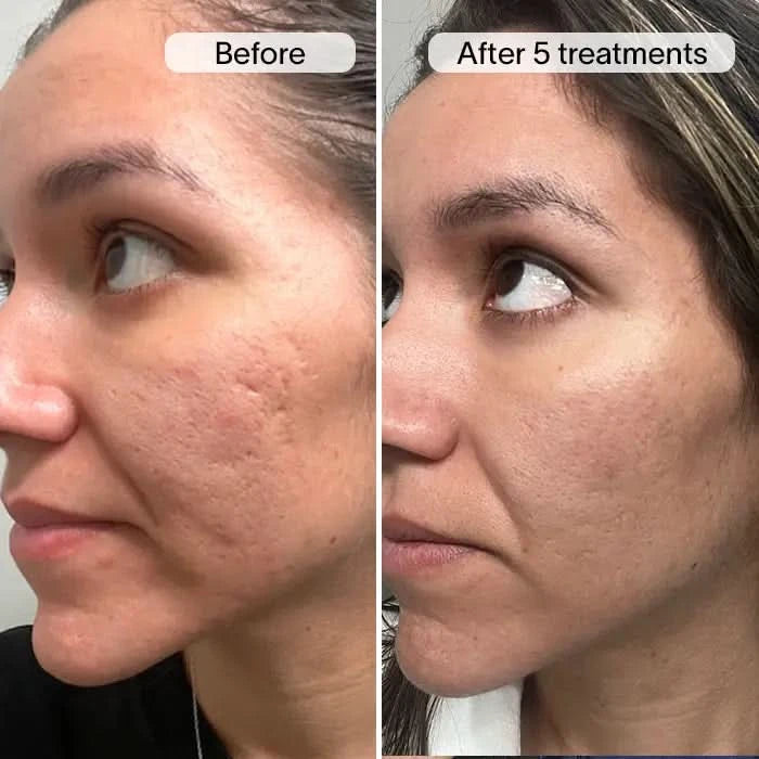 PDRN Advanced Infusion Treatment for Acne Scars