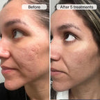 PDRN Advanced Infusion Treatment for Acne Scars