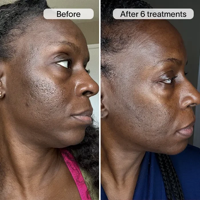 PDRN Advanced Infusion Treatment for Acne Scars