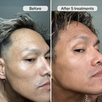 PDRN Advanced Infusion Treatment for Acne Scars