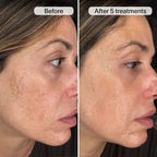 PDRN Advanced Infusion Treatment for Acne Scars