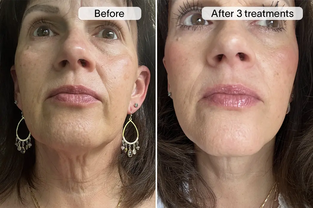 Carrie V. before and after