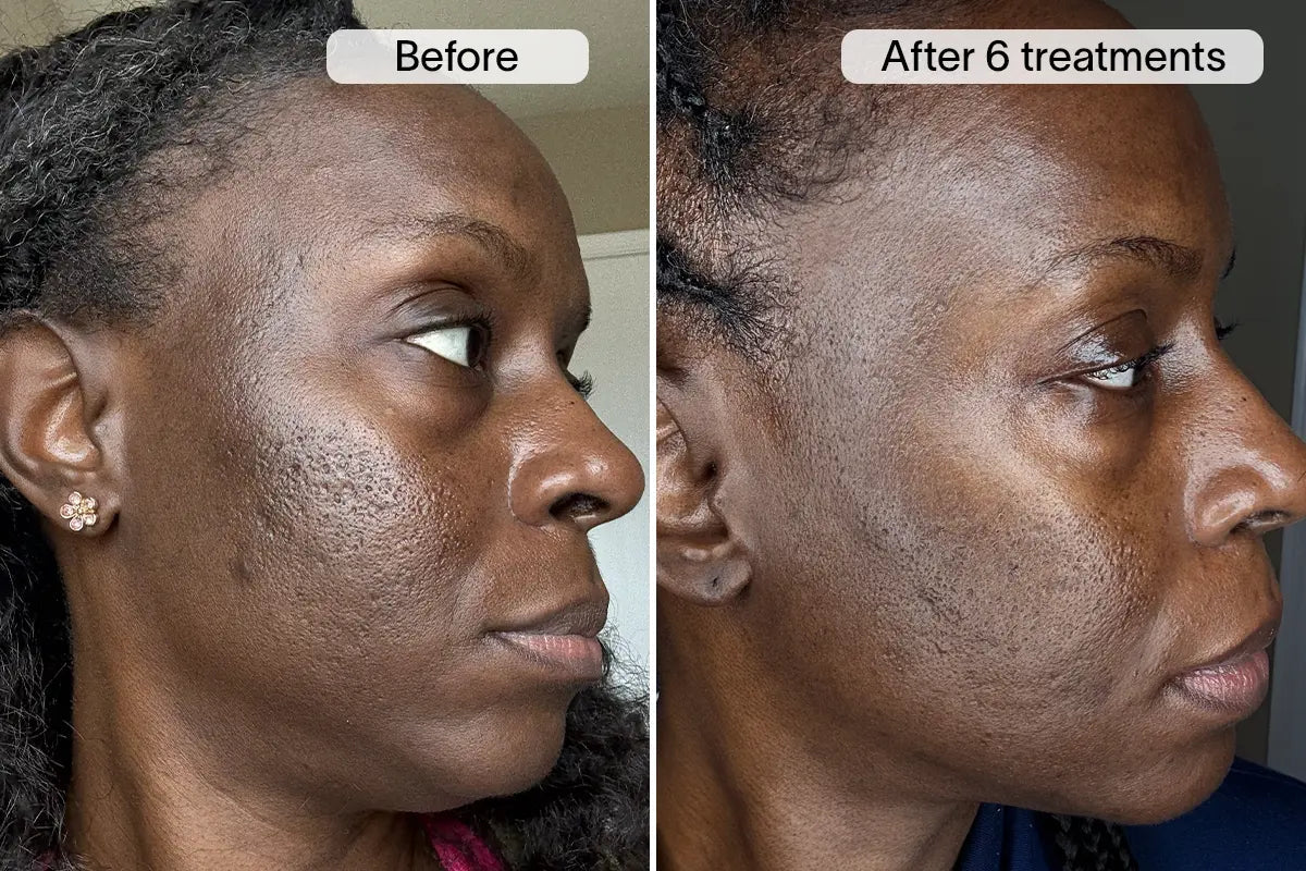 Nichole H. before and after